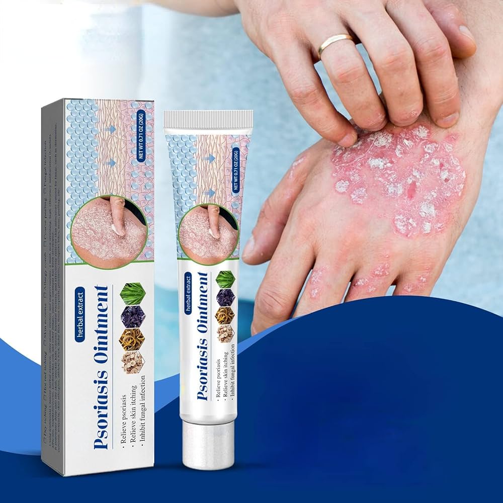 Herbal Psoriasis Ointment